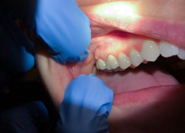 Best Broken Tooth Emergency  in Monticello, MN